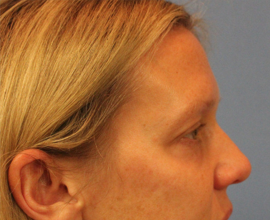 Woman's face, before Blepharoplasty treatment, r-side view