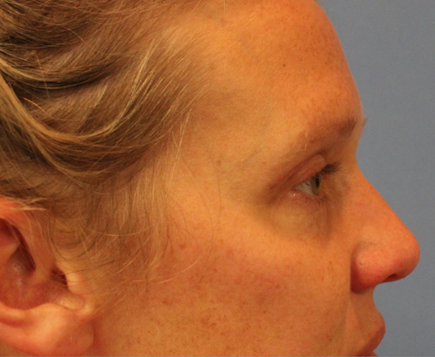 Woman's face, after Blepharoplasty treatment, r-side view