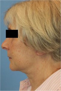 Woman's face, after Face Lift treatment, l-side view, patient 3