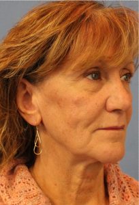 Woman's face, before Face Lift treatment, r-side oblique view, patient 1
