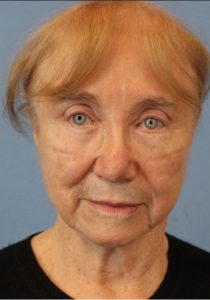 Female face, before Face Lift treatment, front view, patient 8