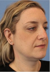 Woman's face, before Face Lift treatment, r-side oblique view, patient 2
