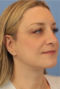 Woman's face, after Face Lift treatment, r-side oblique view, patient 2