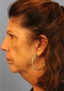 Woman's face, before Face Lift treatment, l-side view, patient 6