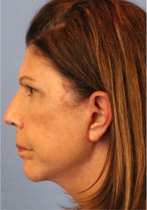 Woman's face, after Face Lift treatment, l-side view, patient 6