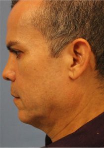 Male face, before Face Lift treatment, l-side view, patient 5