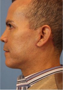 Male face, after Face Lift treatment, l-side view, patient 5