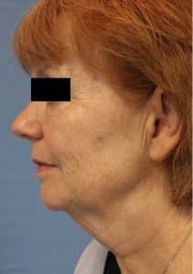 Woman's face, before Face Lift treatment, l-side view, patient 4