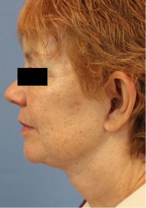 Woman's face, after Face Lift treatment, l-side view, patient 4