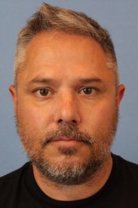 Male face, before Neck Lift treatment, front view, patient 2
