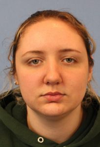 Female face, before Neck Lift treatment, front view, patient 1