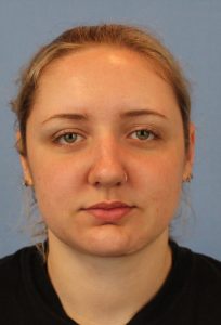 Female face, after Neck Lift treatment, front view, patient 1
