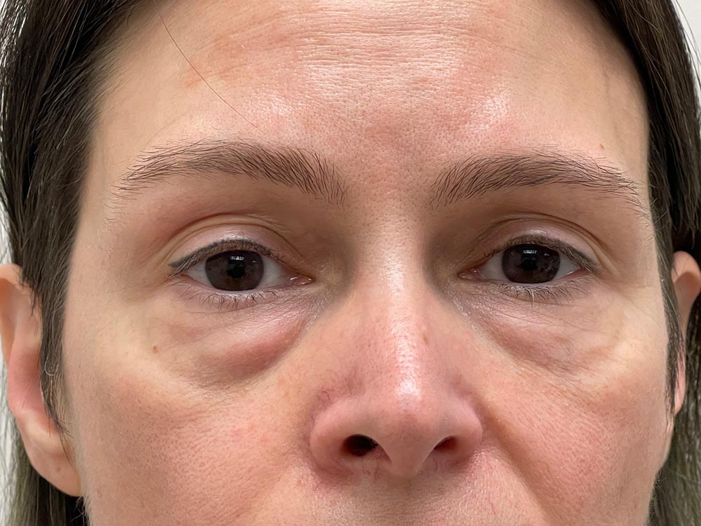 Photo of the patient’s face before the Blepharoplasty surgery. Patient 3 - Set 6