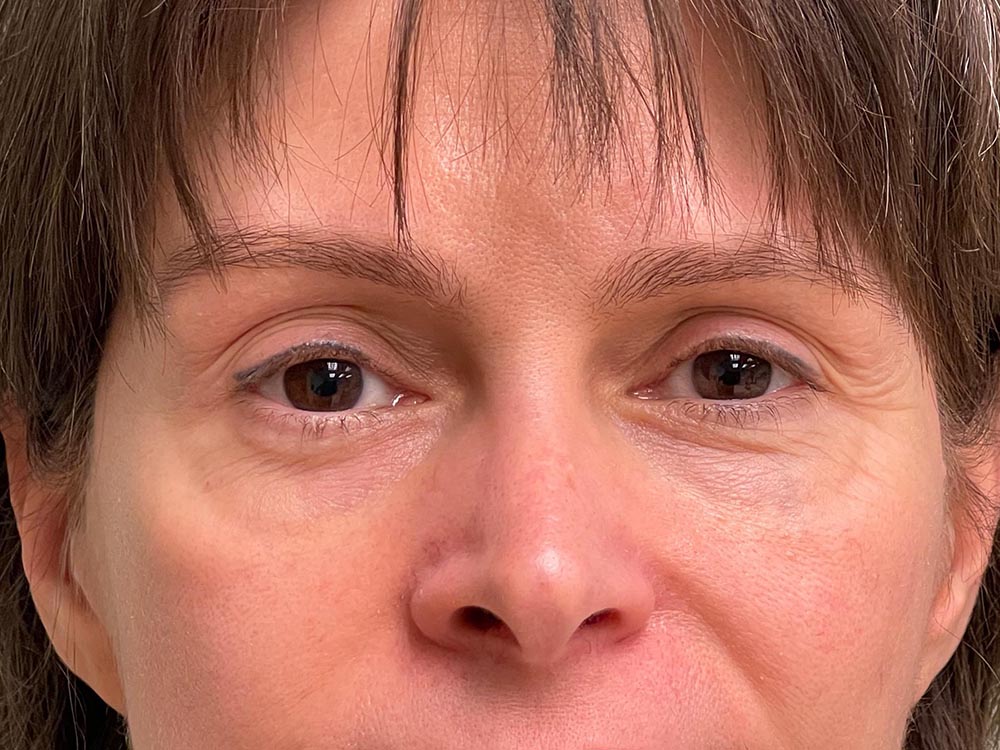 Photo of the patient’s face after the Blepharoplasty surgery. Patient 3 - Set 6
