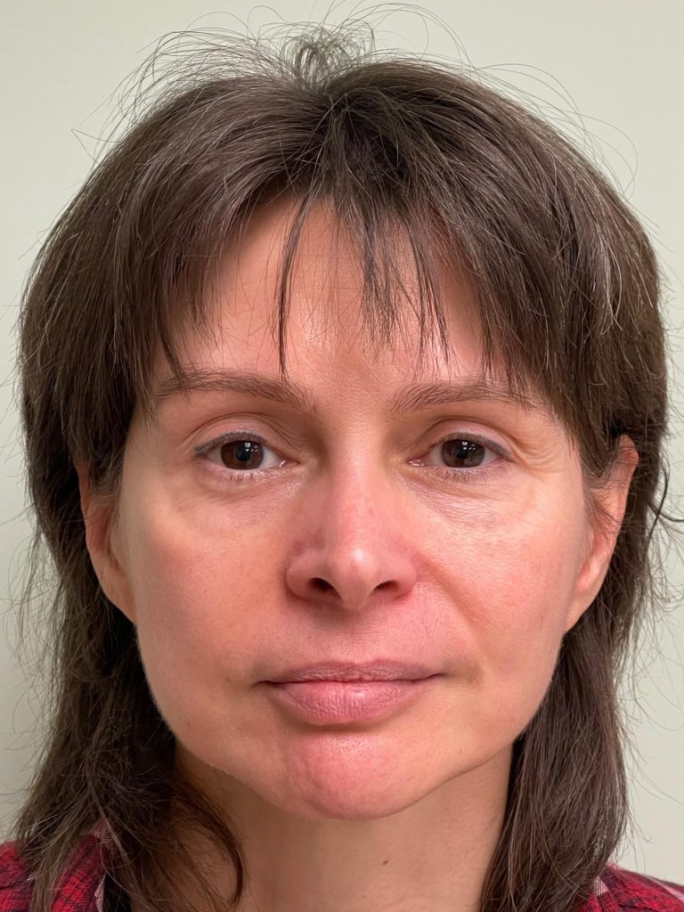 Photo of the patient’s face after the Blepharoplasty surgery. Patient 3 - Set 1