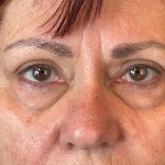 Photo of the patient’s face before the Blepharoplasty surgery. Patient 2 - Set 6