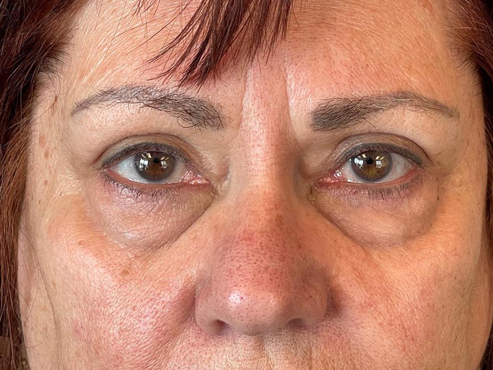 Photo of the patient’s face before the Blepharoplasty surgery. Patient 2 - Set 6