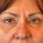 Photo of the patient’s face after the Blepharoplasty surgery. Patient 2 - Set 6