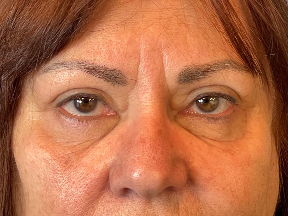 Photo of the patient’s face after the Blepharoplasty surgery. Patient 2 - Set 6