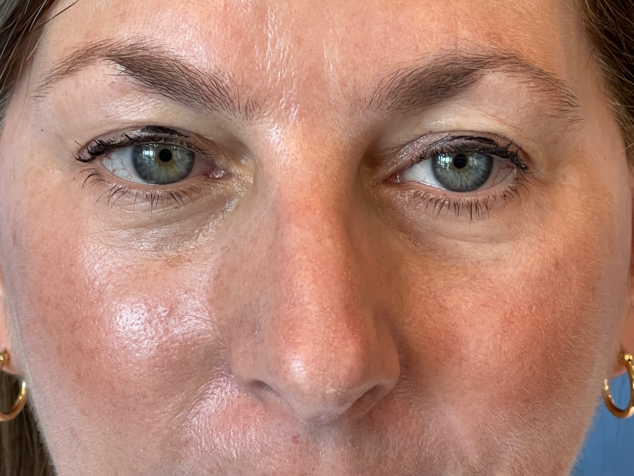 Photo of the patient’s face before the Blepharoplasty surgery. Patient 6 - Set 6