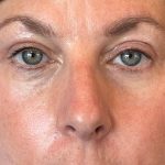 Photo of the patient’s face after the Blepharoplasty surgery. Patient 6 - Set 6
