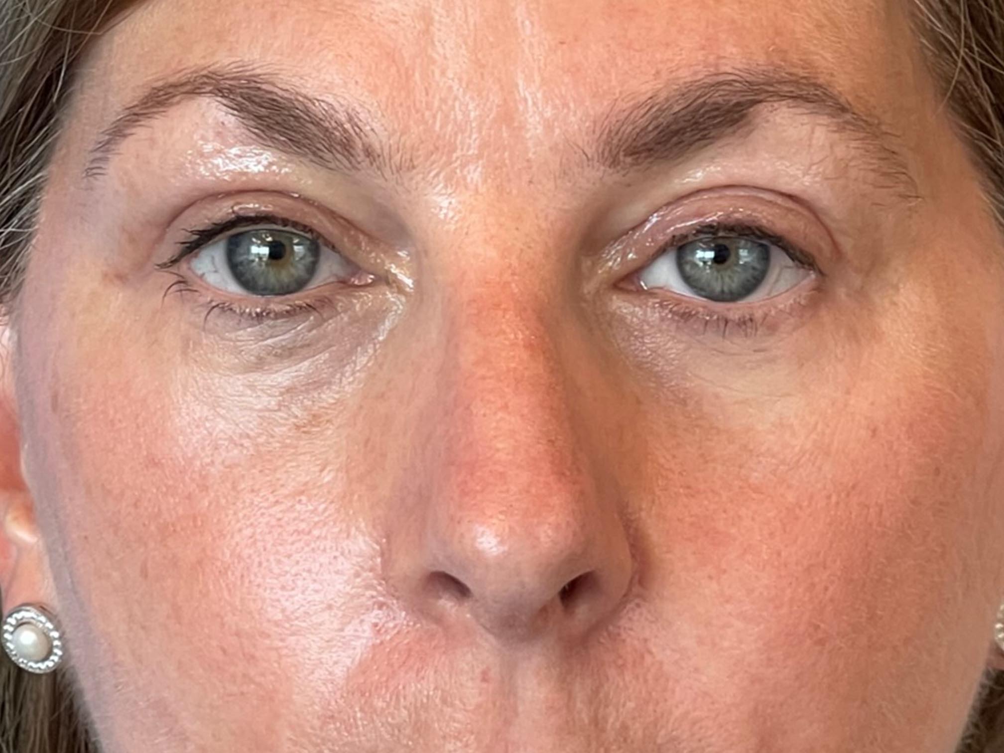 Photo of the patient’s face after the Blepharoplasty surgery. Patient 6 - Set 6
