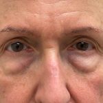 Photo of the patient’s face before the Blepharoplasty surgery. Patient 4 - Set 5