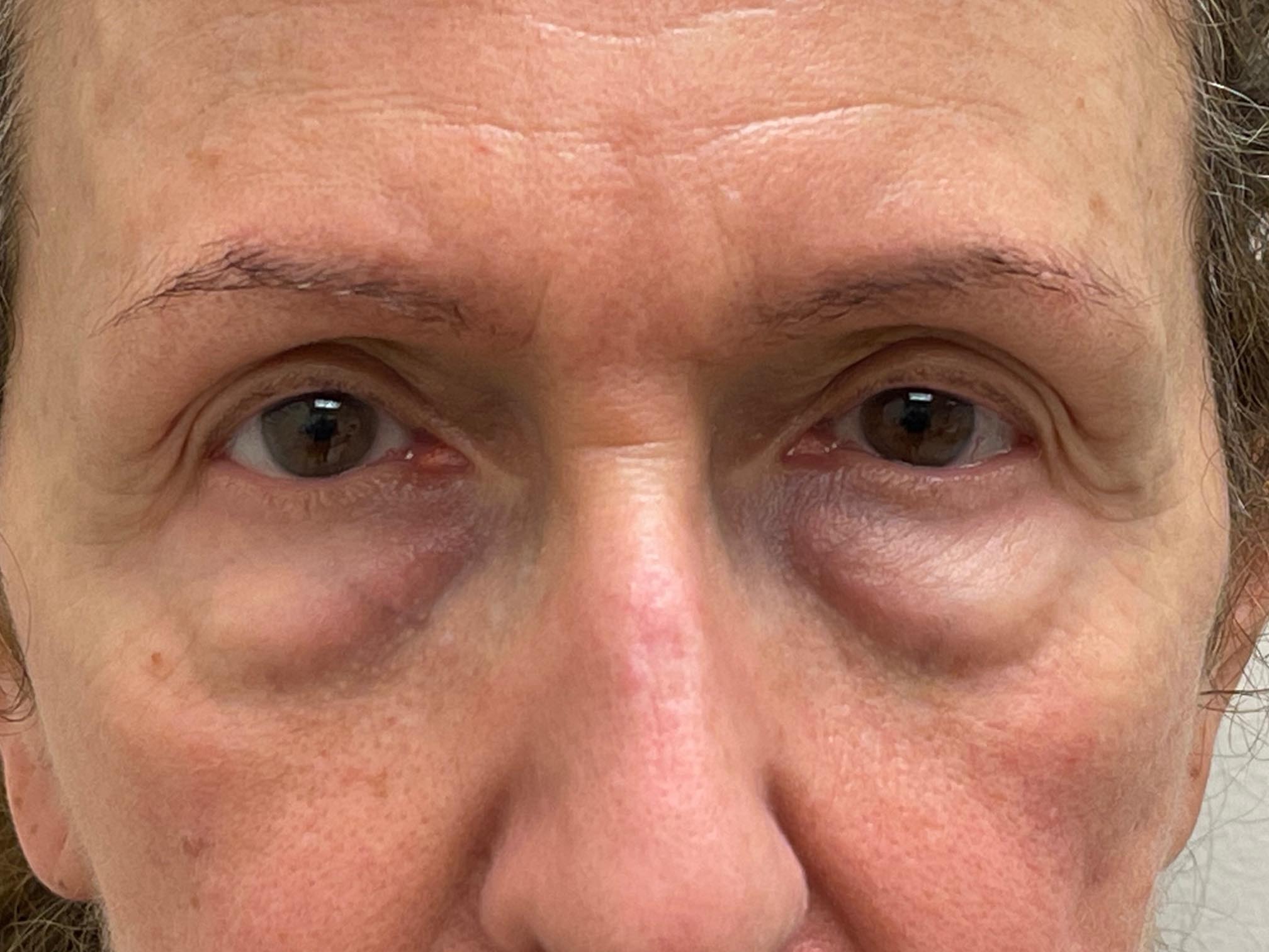 Photo of the patient’s face before the Blepharoplasty surgery. Patient 4 - Set 5
