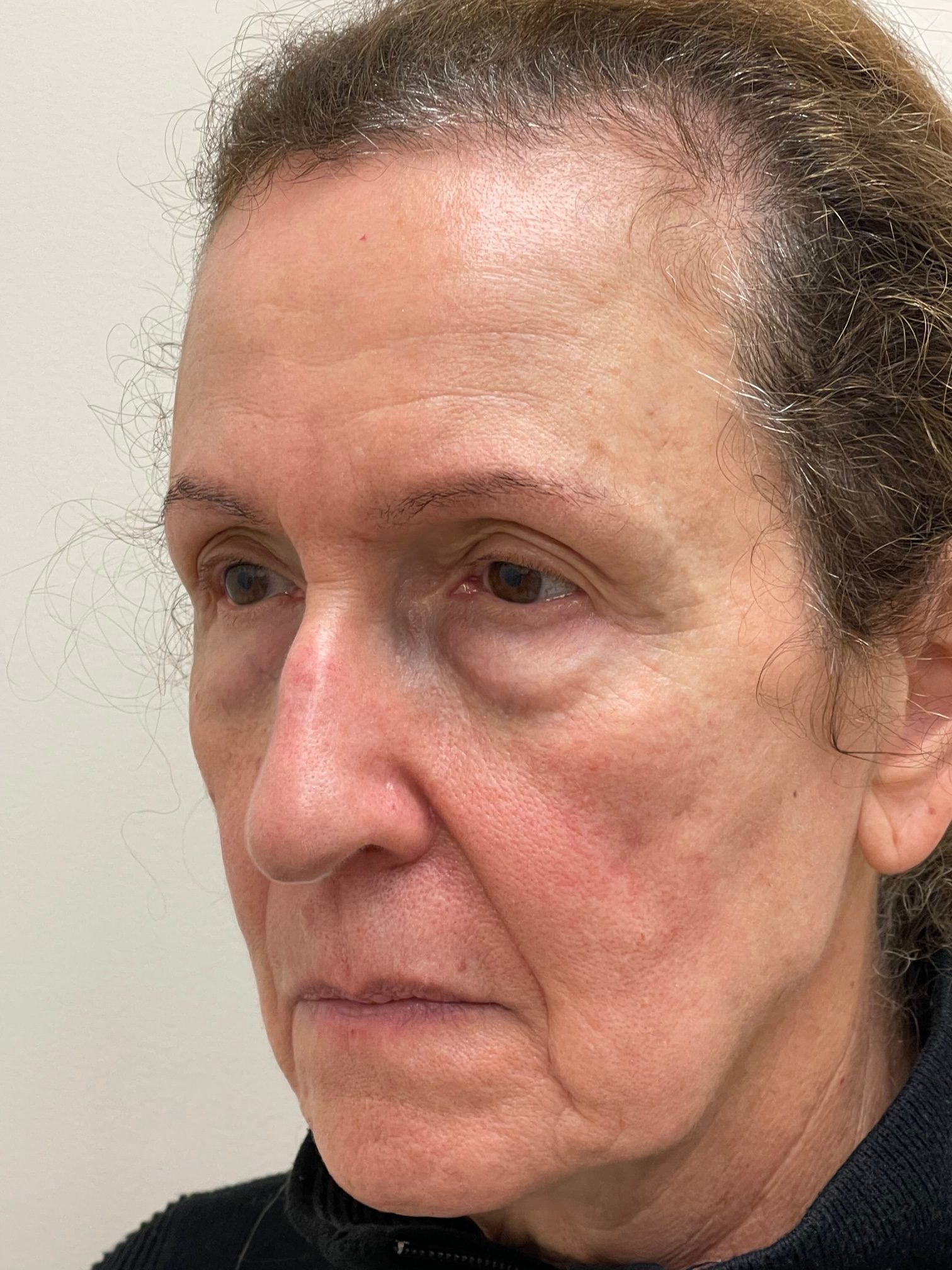 Photo of the patient’s face before the Blepharoplasty surgery. Patient 4 - Set 1