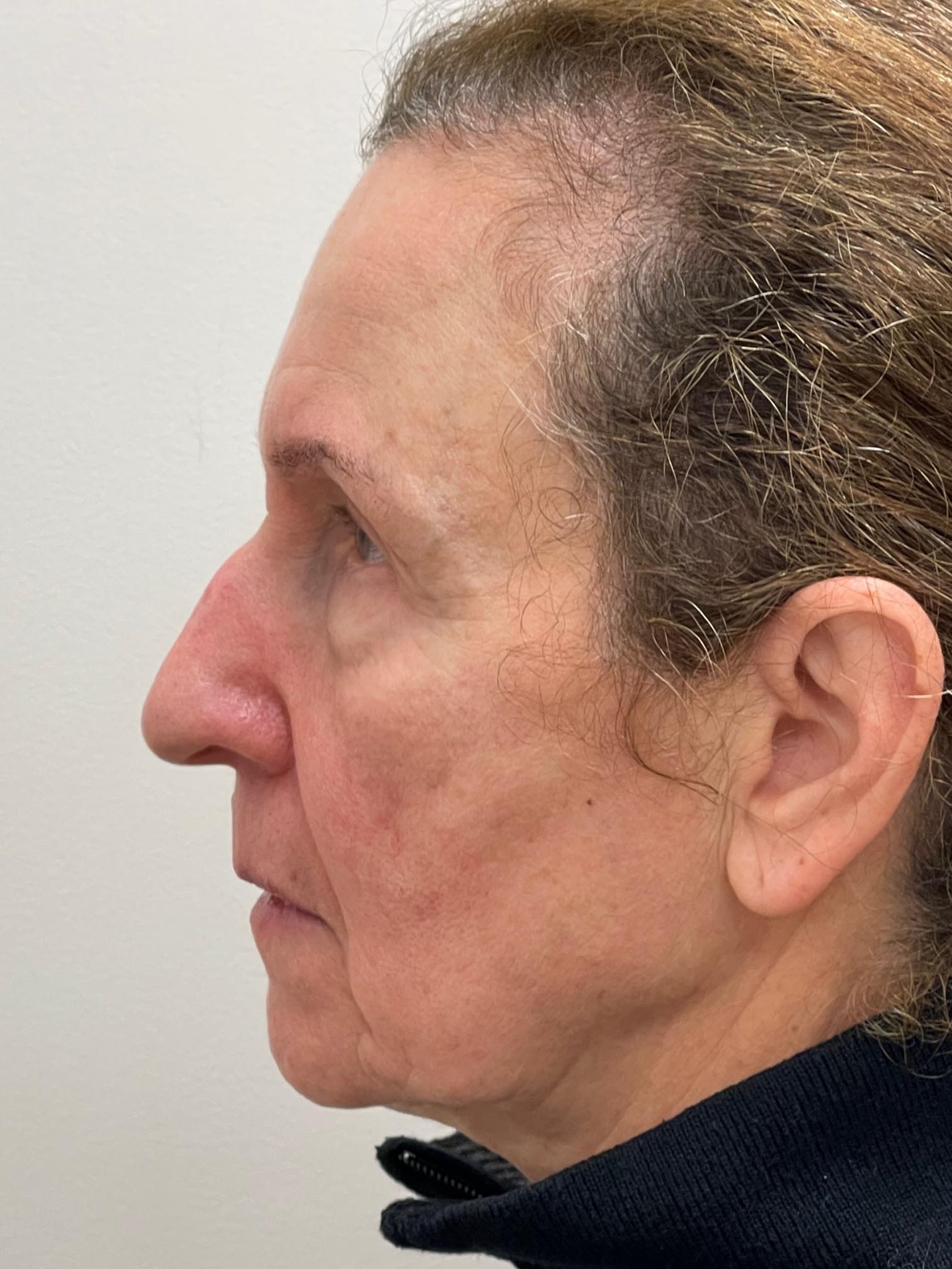 Photo of the patient’s face before the Blepharoplasty surgery. Patient 4 - Set 2