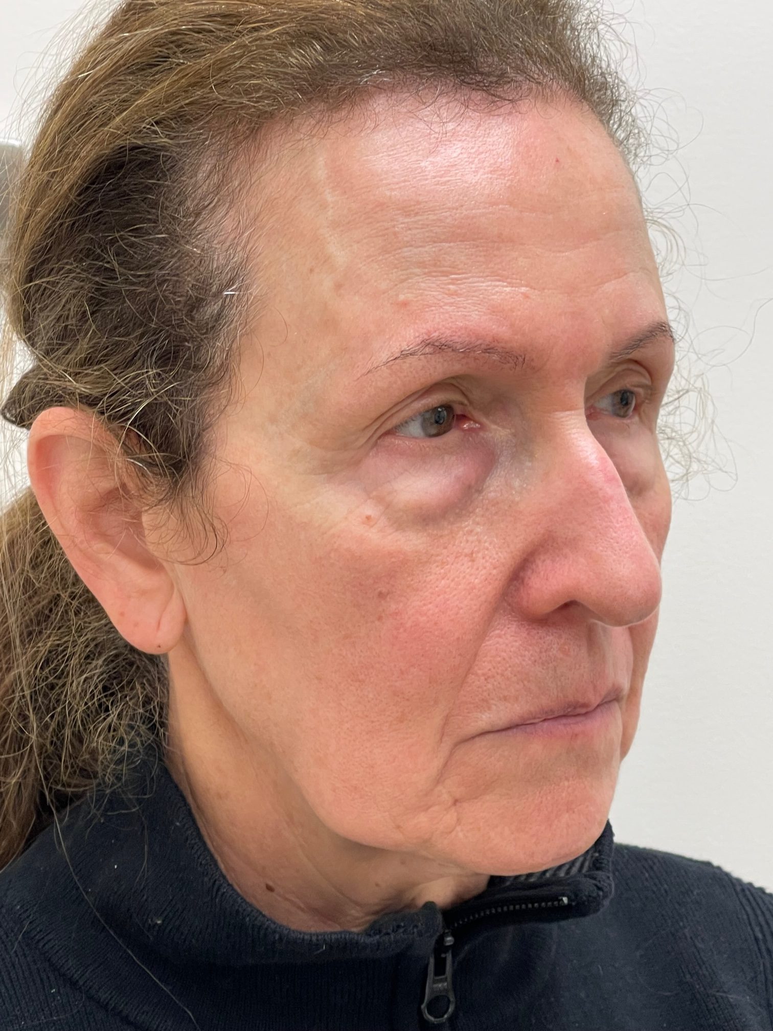 Photo of the patient’s face before the Blepharoplasty surgery. Patient 4 - Set 3