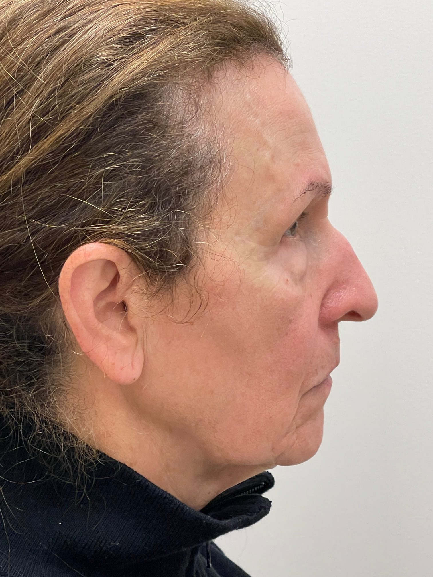 Photo of the patient’s face before the Blepharoplasty surgery. Patient 4 - Set 4