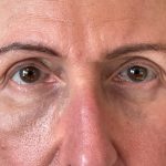 Photo of the patient’s face after the Blepharoplasty surgery. Patient 4 - Set 5