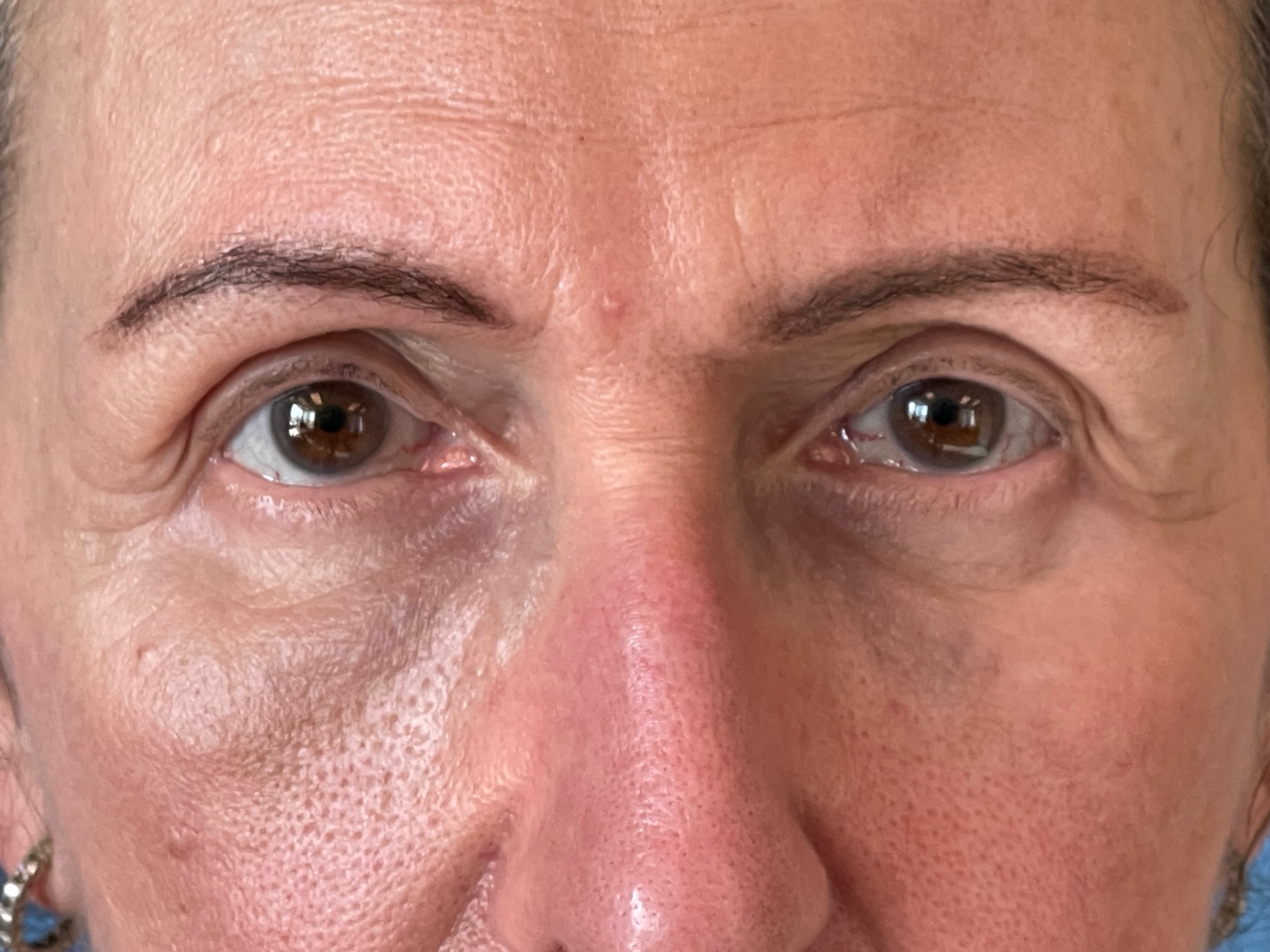 Photo of the patient’s face after the Blepharoplasty surgery. Patient 4 - Set 5
