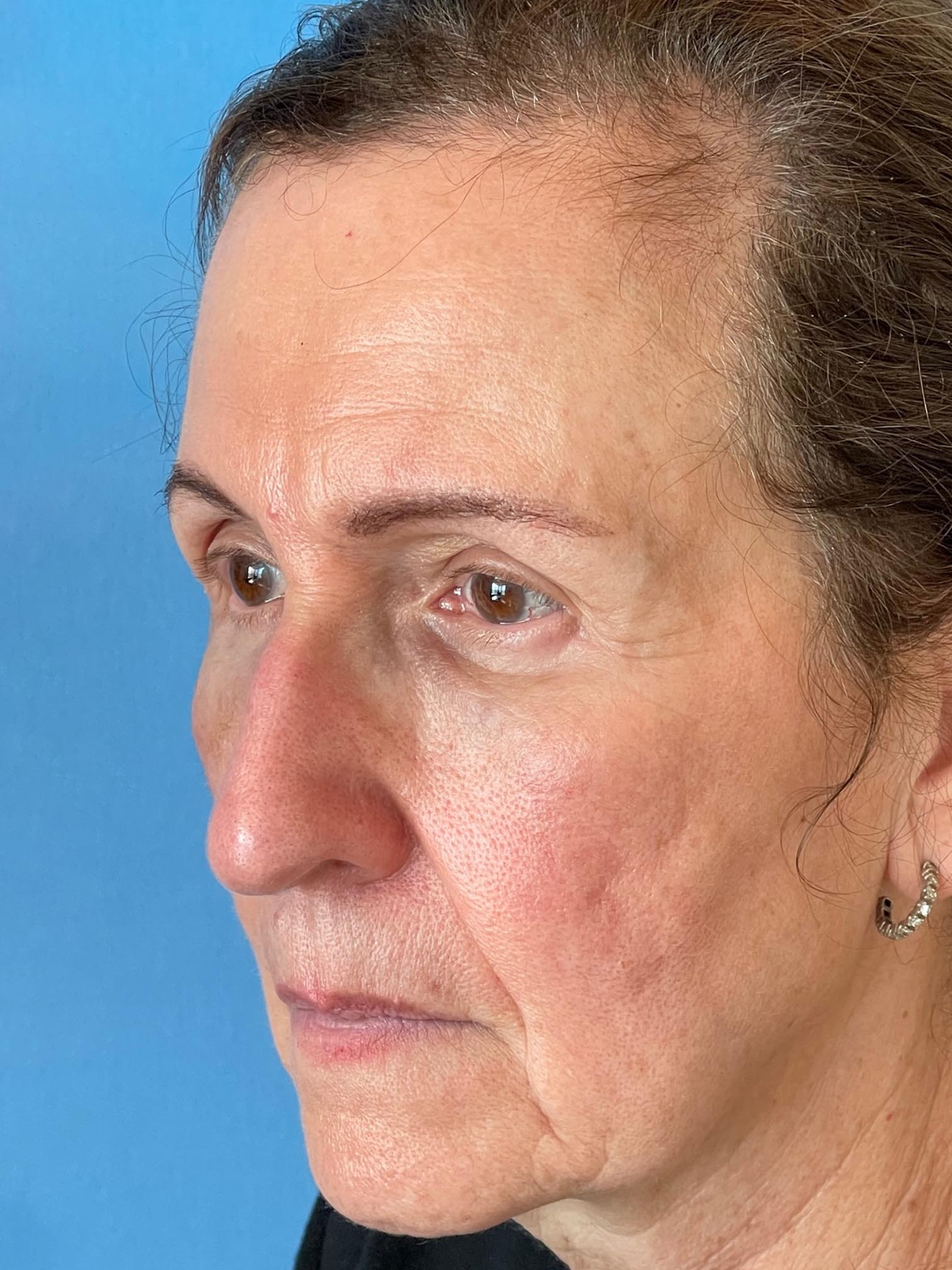 Photo of the patient’s face after the Blepharoplasty surgery. Patient 4 - Set 1