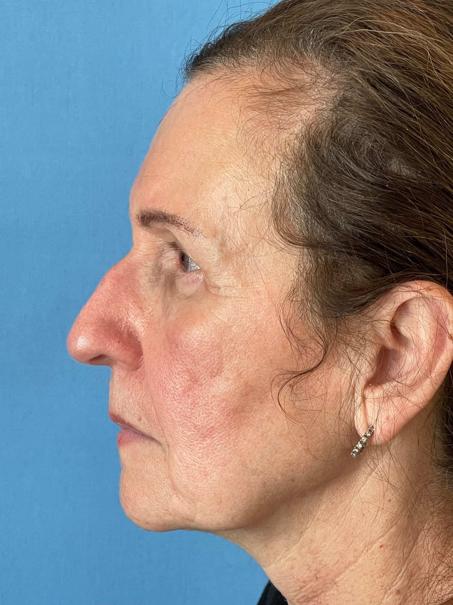 Photo of the patient’s face after the Blepharoplasty surgery. Patient 4 - Set 2