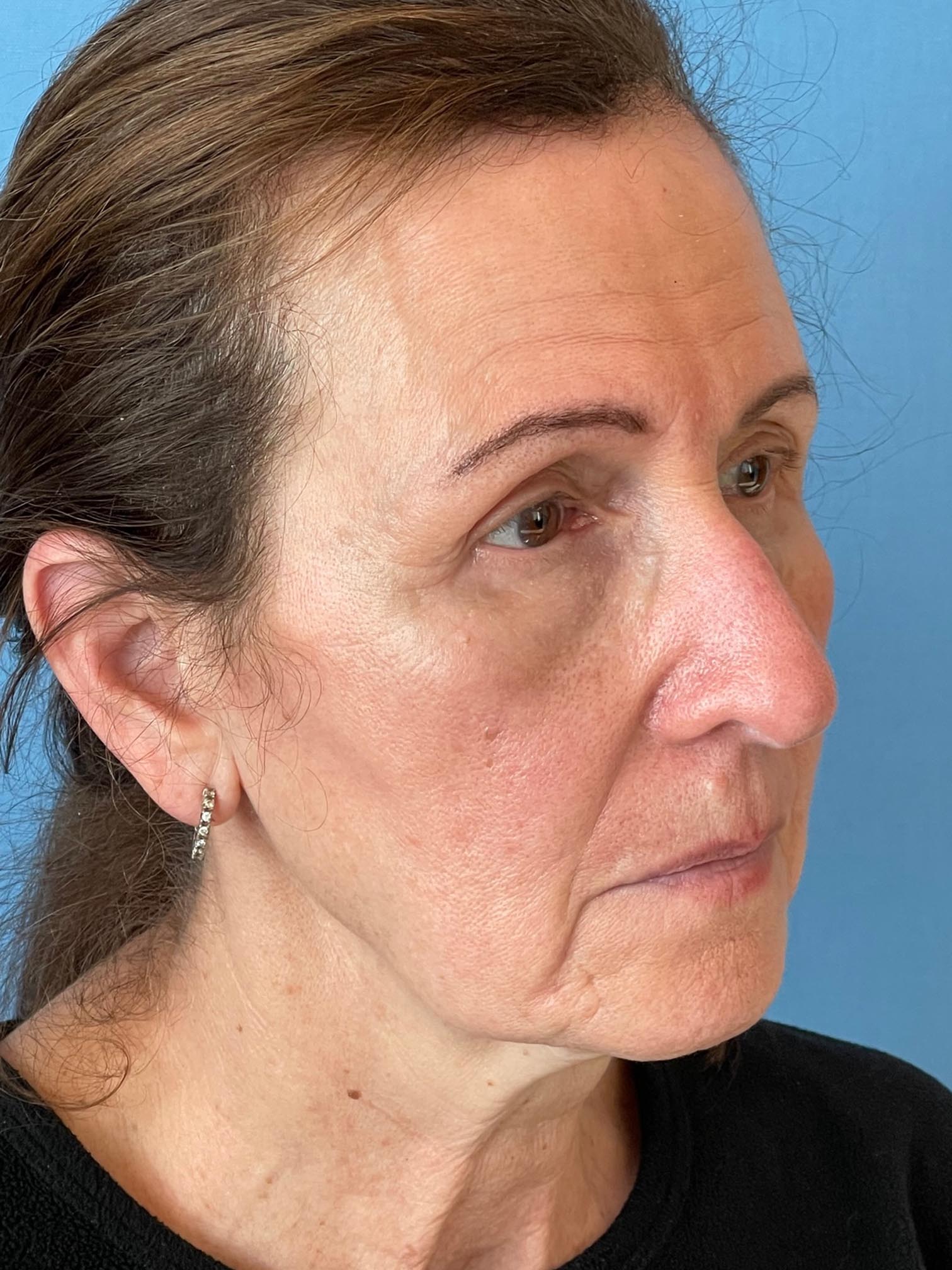 Photo of the patient’s face after the Blepharoplasty surgery. Patient 4 - Set 3