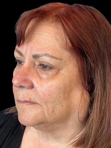 Photo of the patient’s face before the Blepharoplasty surgery. Patient 2 - Set 2