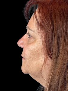 Photo of the patient’s face before the Blepharoplasty surgery. Patient 2 - Set 3