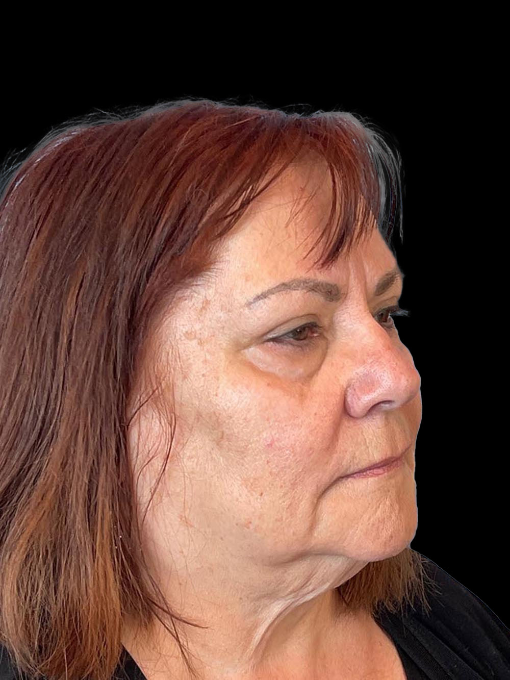 Photo of the patient’s face before the Blepharoplasty surgery. Patient 2 - Set 4