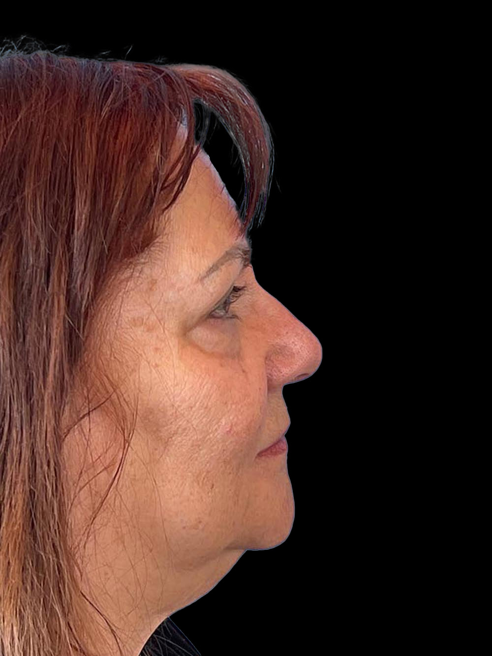 Photo of the patient’s face before the Blepharoplasty surgery. Patient 2 - Set 5