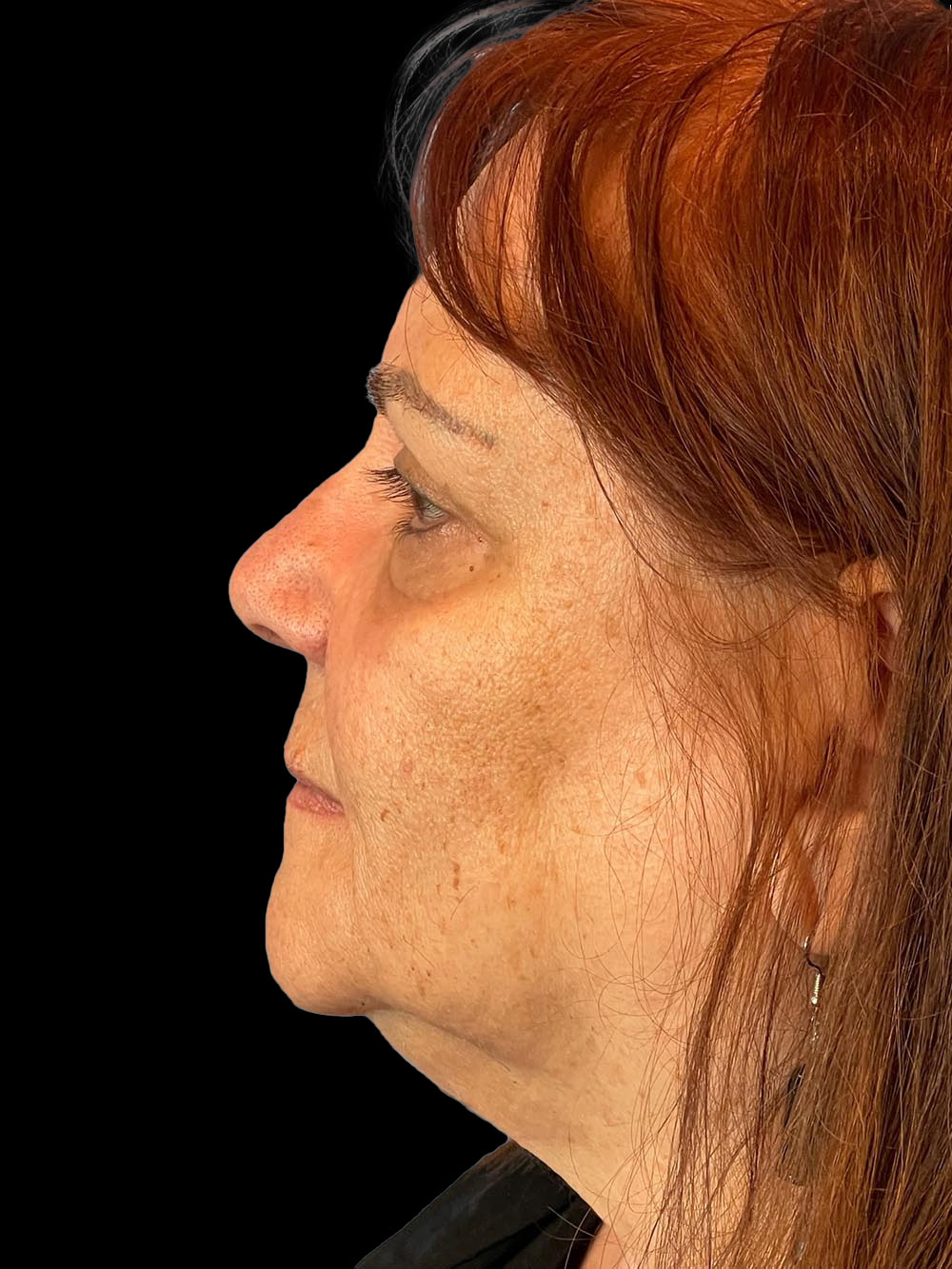 Photo of the patient’s face after the Blepharoplasty surgery. Patient 2 - Set 3