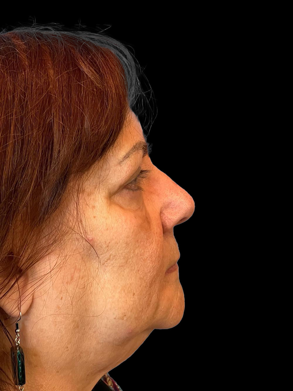 Photo of the patient’s face after the Blepharoplasty surgery. Patient 2 - Set 5