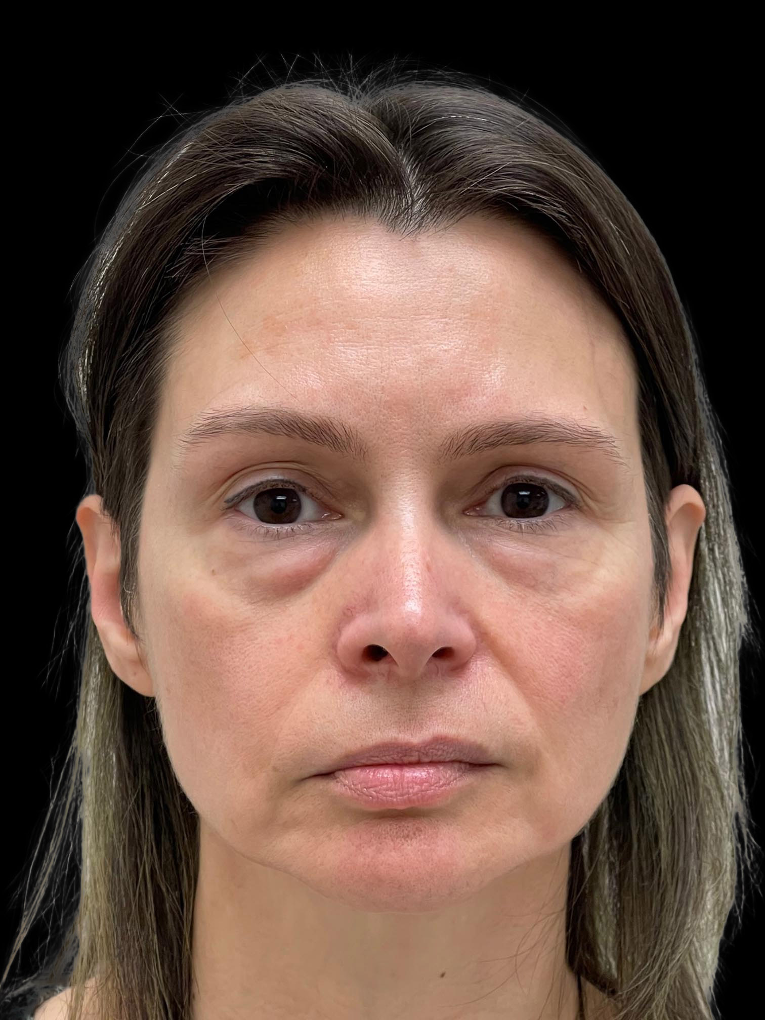 Photo of the patient’s face before the Blepharoplasty surgery. Patient 3 - Set 1