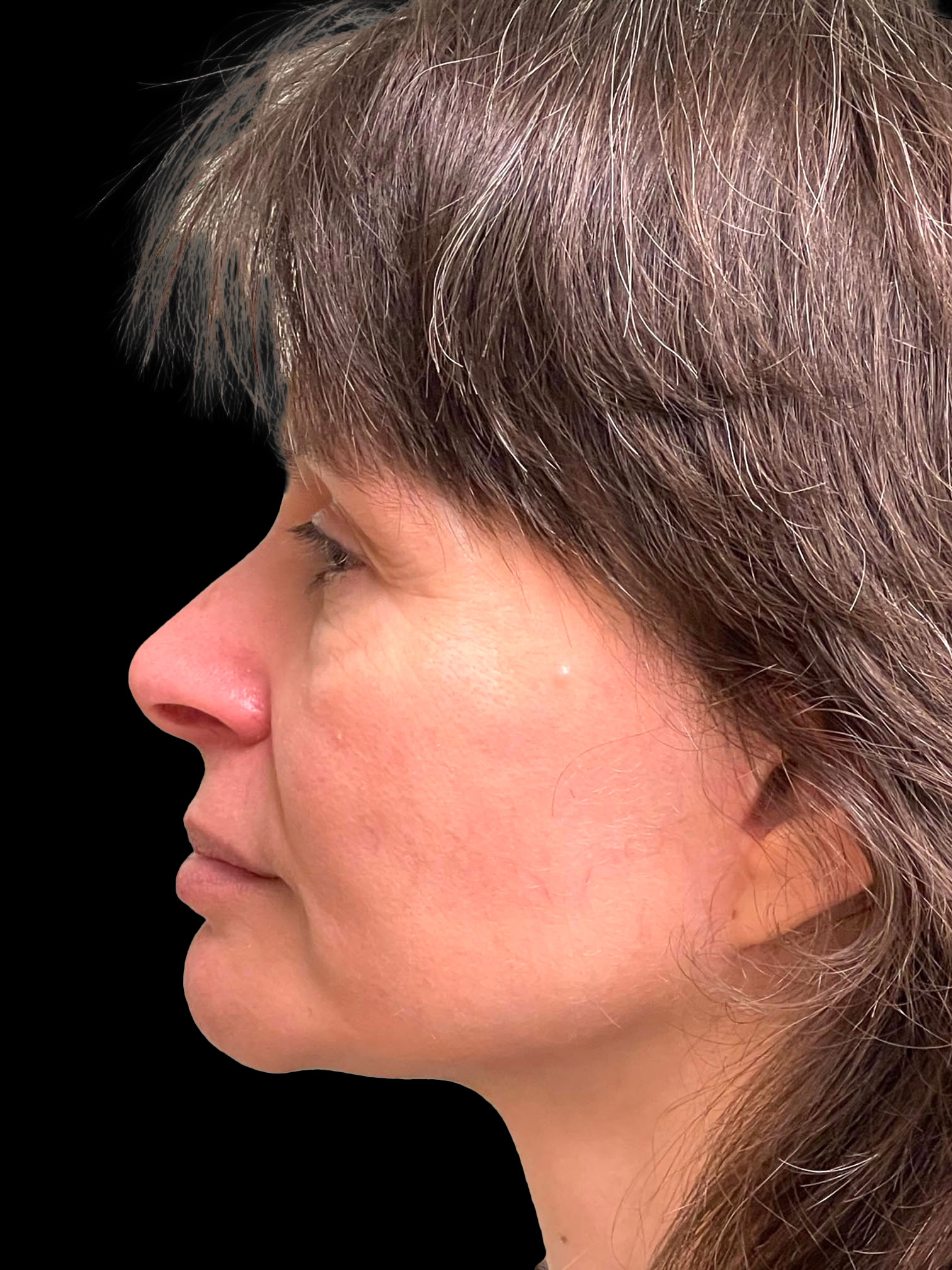 Photo of the patient’s face after the Blepharoplasty surgery. Patient 3 - Set 3