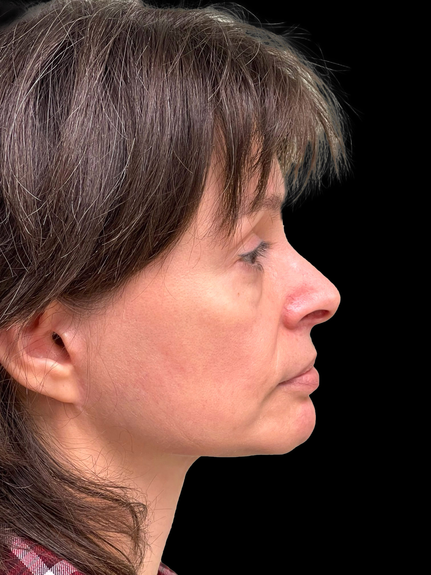Photo of the patient’s face after the Blepharoplasty surgery. Patient 3 - Set 5