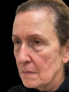 Photo of the patient’s face before the Blepharoplasty surgery. Patient 4 - Set 1