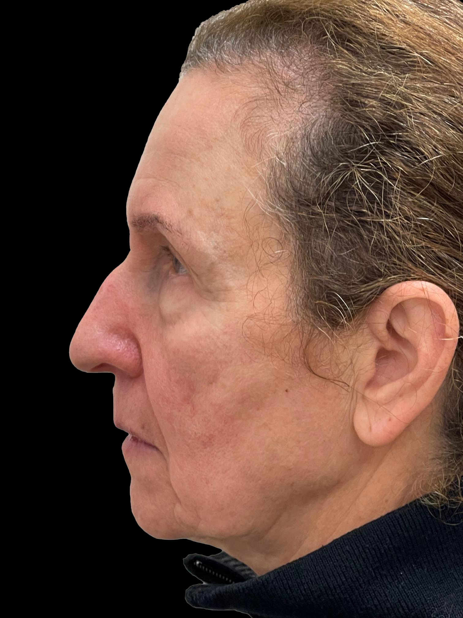 Photo of the patient’s face before the Blepharoplasty surgery. Patient 4 - Set 2