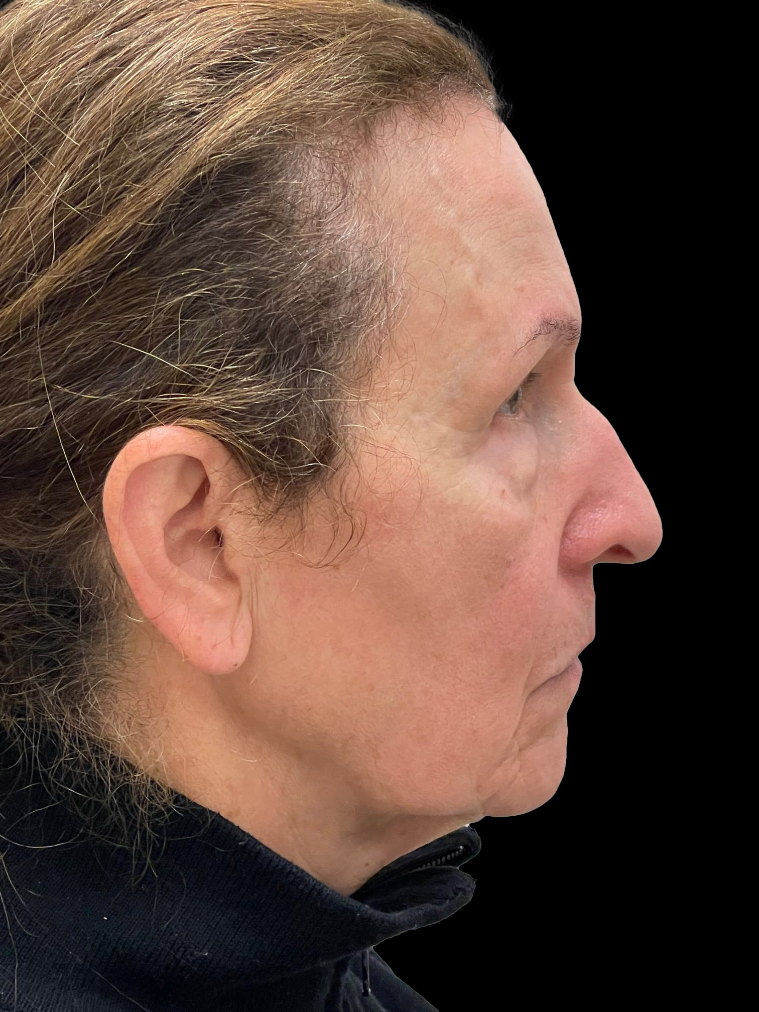 Photo of the patient’s face before the Blepharoplasty surgery. Patient 4 - Set 4