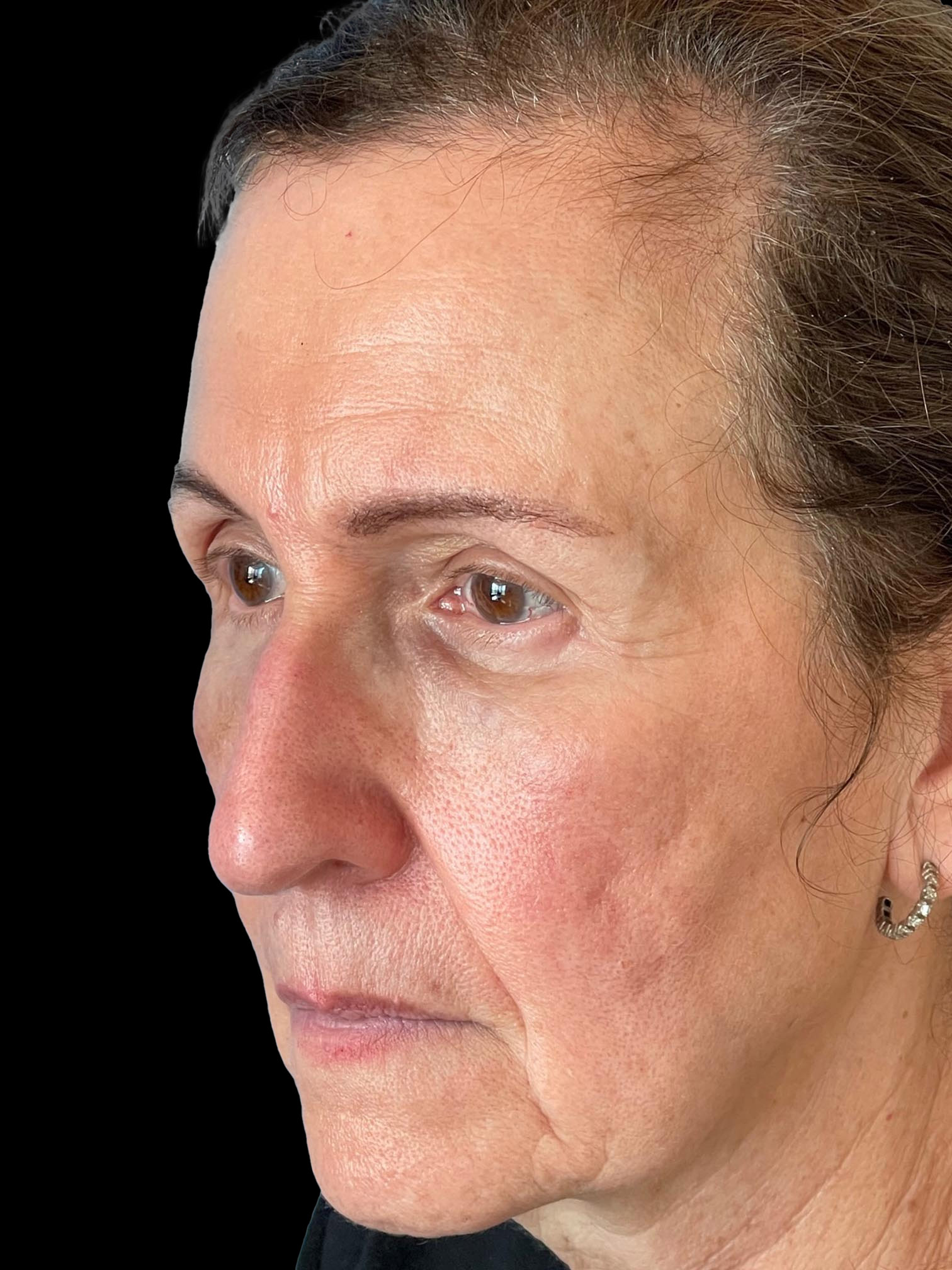 Photo of the patient’s face after the Blepharoplasty surgery. Patient 4 - Set 1